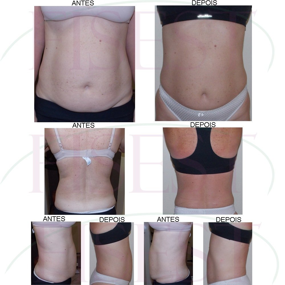 Antes_Depois_JH_ após_9_meses_Fisest